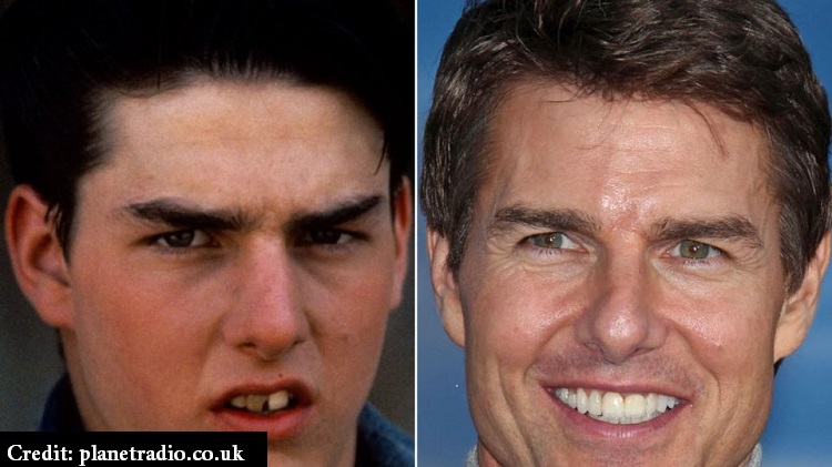 10 Celebrities with Chipped Teeth – The Lifestyle Magazine